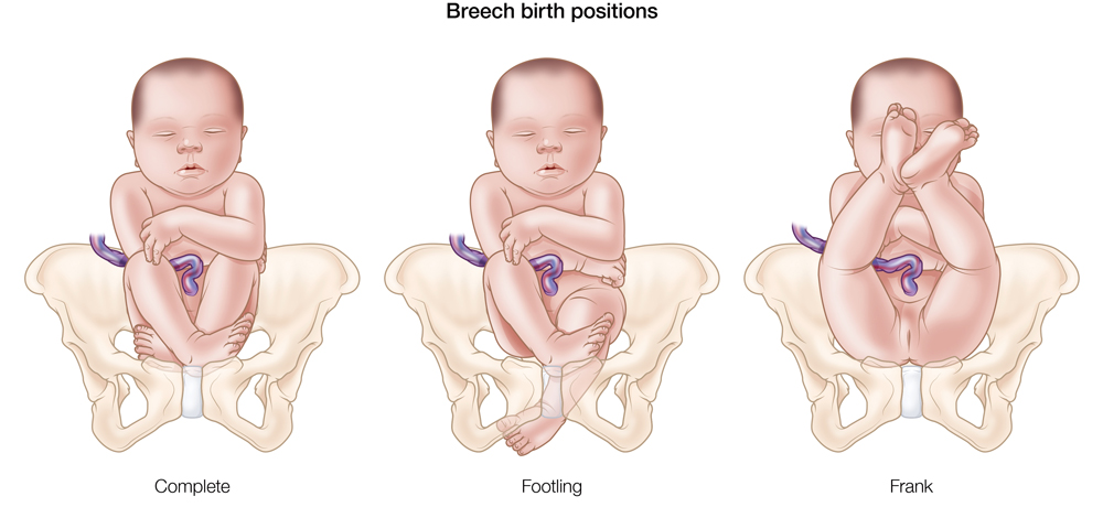 Breech baby deals head up